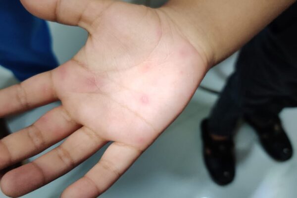 A close-up of a child's hand showing small red blisters and spots characteristic of Hand, Foot, and Mouth Disease (HFMD).