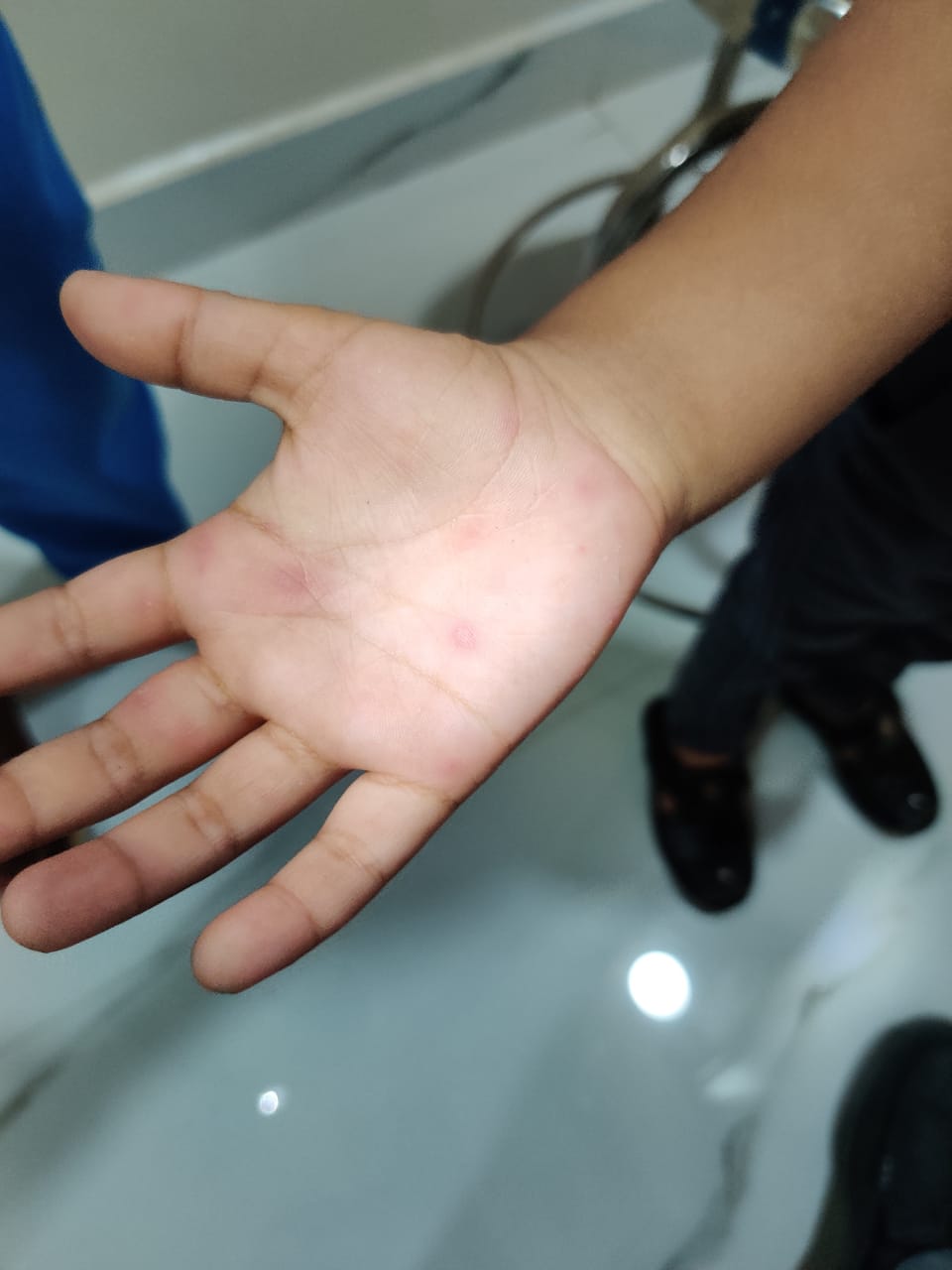 A close-up of a child's hand showing small red blisters and spots characteristic of Hand, Foot, and Mouth Disease (HFMD).