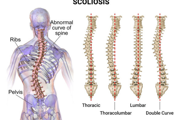 Understanding Scoliosis: A Complete Guide to Spinal Curvature